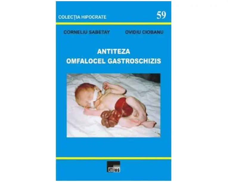 Antiteza omfalocel gastroschizis - Corneliu Sabetay, Ovidiu Ciobanu